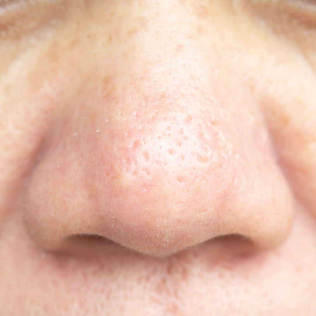 Why are my pores getting bigger as I age? – QYRAL